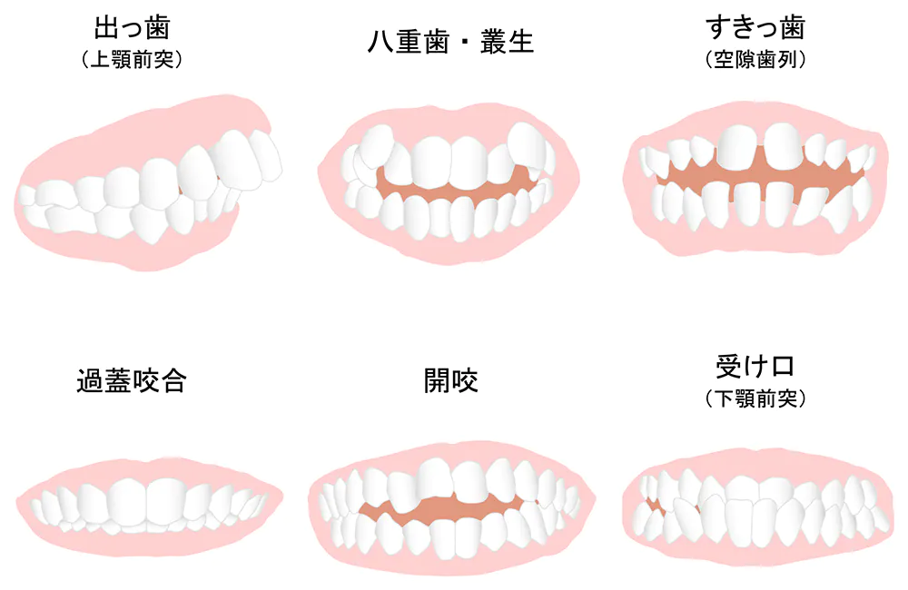 不正咬合とは