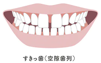 すきっ歯（八重歯）