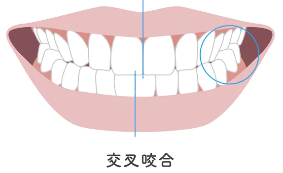 マウスピース矯正の適応症状