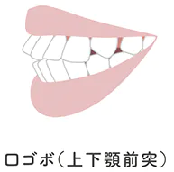 前歯が出てしまう（上顎前突、下顎前突）