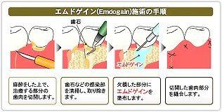 エムドゲイン（歯周再生療法）