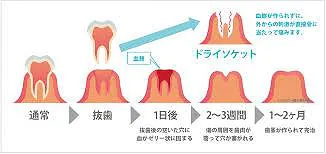 こんなケースがあります～凄く痛い、ドライソケット～